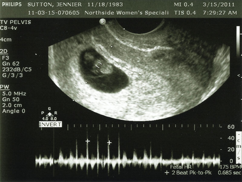 Week ultrasound 8 normal Ultrasound At