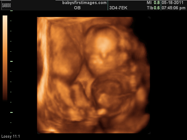 3D Ultrasound Image