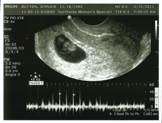 8 Week Heartbeat Ultrasound