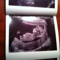 Week 12 Ultrasound – Fetal Nuchal Translucency Test Via Ultrasound