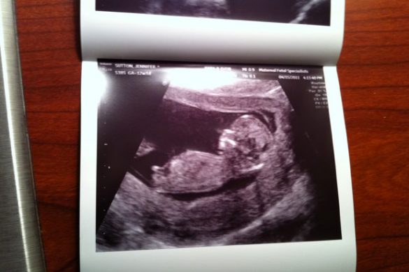 12 Week Ultrasound Picture