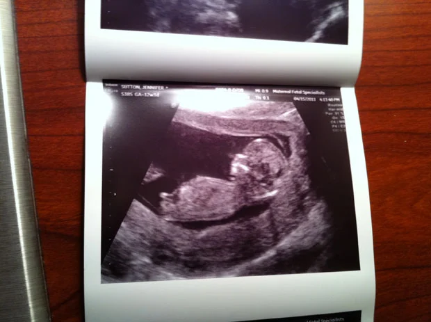 Week 12 Ultrasound – Fetal Nuchal Translucency Test Via Ultrasound