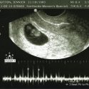 8 Week Ultrasound: The Moment Of Truth