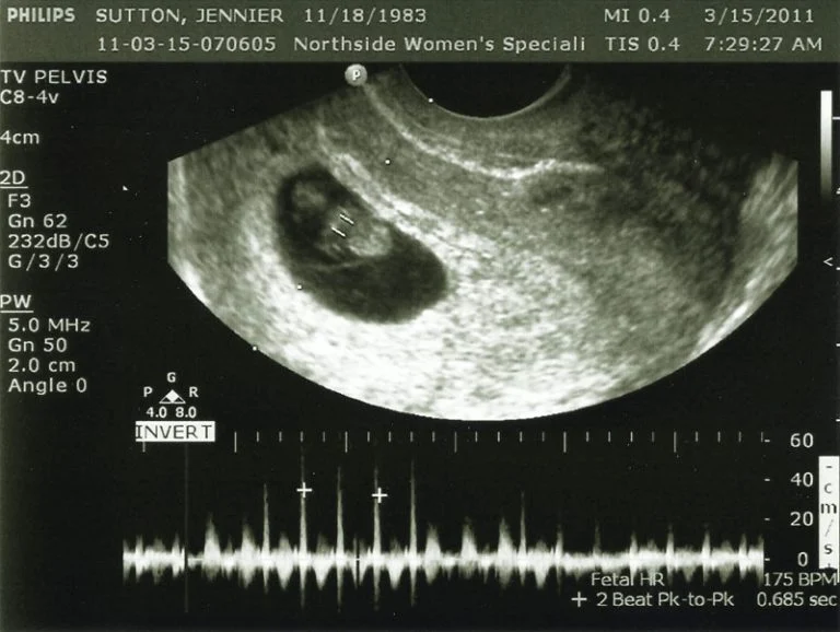 8 Week Ultrasound: The Moment Of Truth