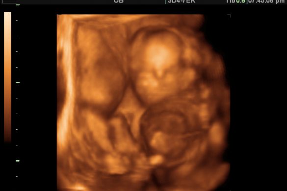 3D Ultrasound Image