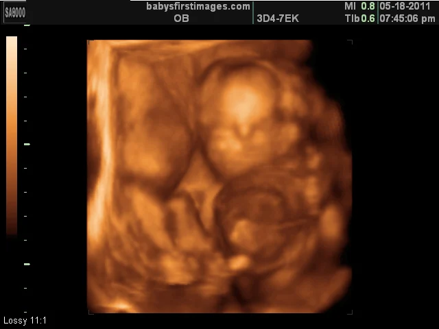 3D Ultrasound Image 3D Ultrasound Image